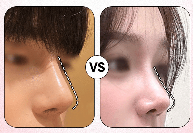 韓国整形　鼻整形　症例写真　ビフォーアフター