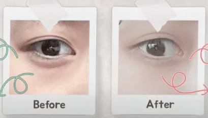 韓国整形　眼下脂肪再配置　韓国美容外科　渡韓整形　下眼瞼　症例写真