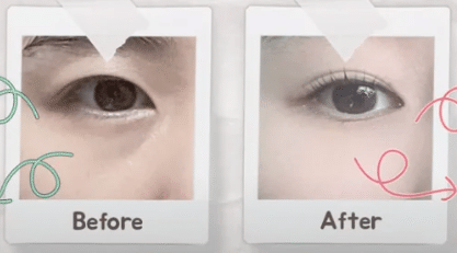 韓国整形　眼下脂肪再配置　韓国美容外科　渡韓整形　症例写真　アンチエイジング