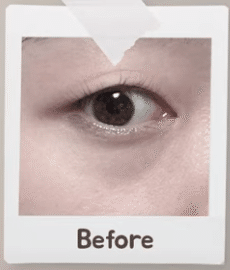韓国整形　眼下脂肪再配置　韓国美容外科　渡韓整形　下眼瞼　アンチエイジング