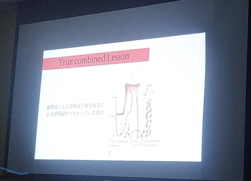 エンドペリオ病変(歯内﹣歯周病変)の改訂｜二井 愛子(歯科衛生士)🎈
