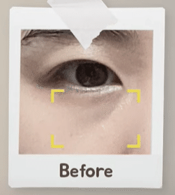 韓国整形　眼下脂肪再配置　韓国美容外科　渡韓整形　下眼瞼　アンチエイジング