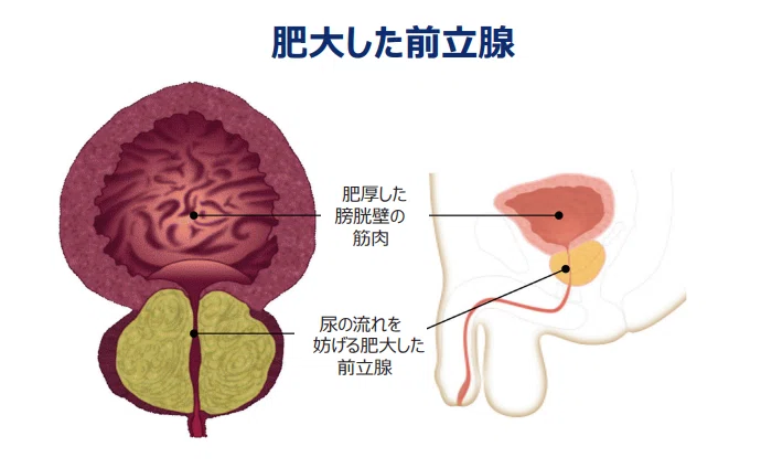 「こまど」12月号に載っている前立腺肥大症の新しい手術とは？｜名古屋市中村区のそえだ腎・泌尿器科クリニック 副田雄也 