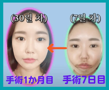 韓国整形　美容外科　渡韓整形　輪郭整形　ダウンタイム　症例写真
