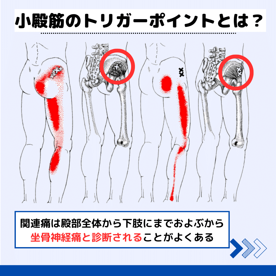 トリガーポイント　整骨院　カイロプラクティック　整体 トリガーポイント 整骨院 カイロプラクティック 整体