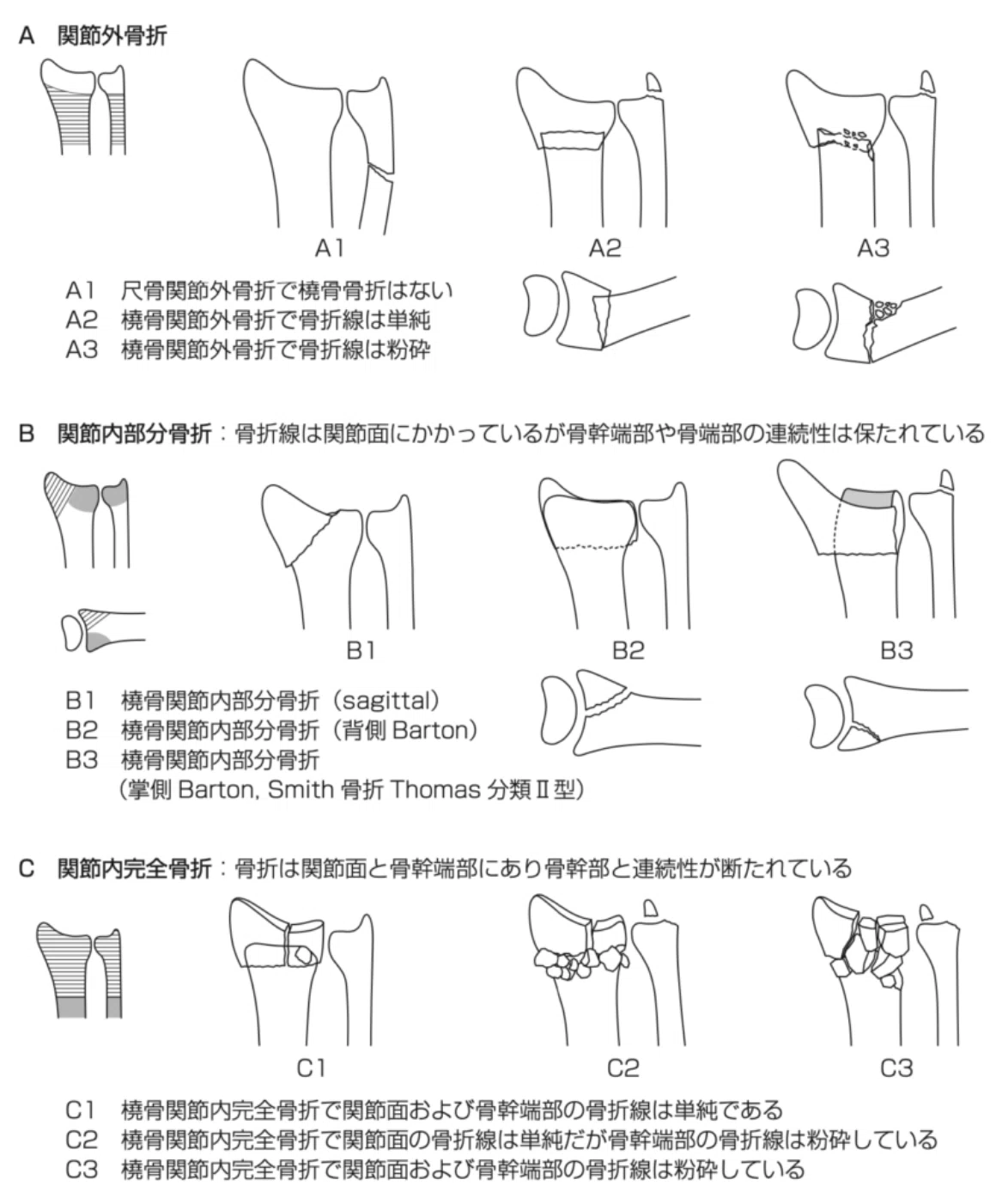橈骨遠位端骨折(Distal radius fracture：DRF)｜あひるOT