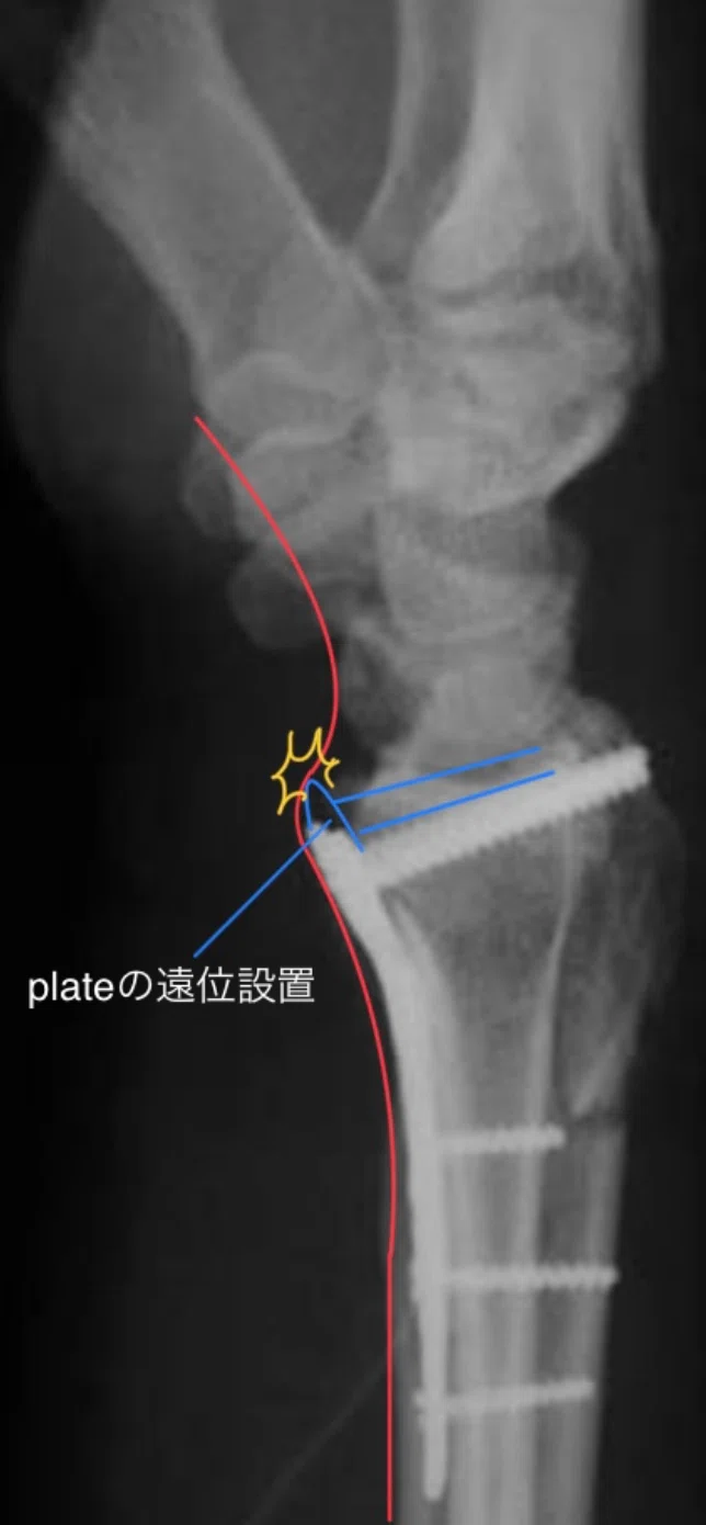 橈骨遠位端骨折(Distal radius fracture：DRF)｜あひるOT