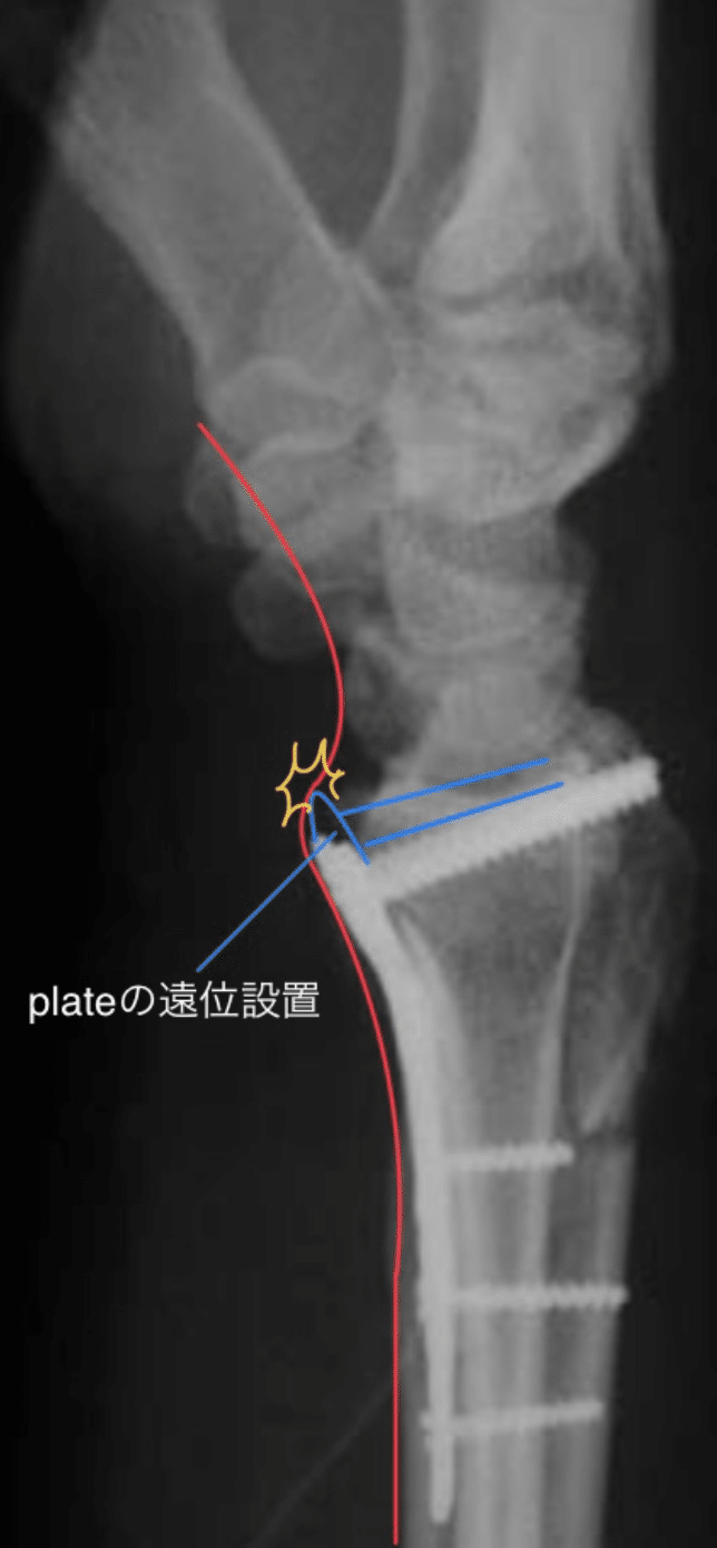 グランド牧場 セレクトセール スペシャル特典 高齢者橈骨遠位端骨折の治療−早期ADL回復を 健康・医学