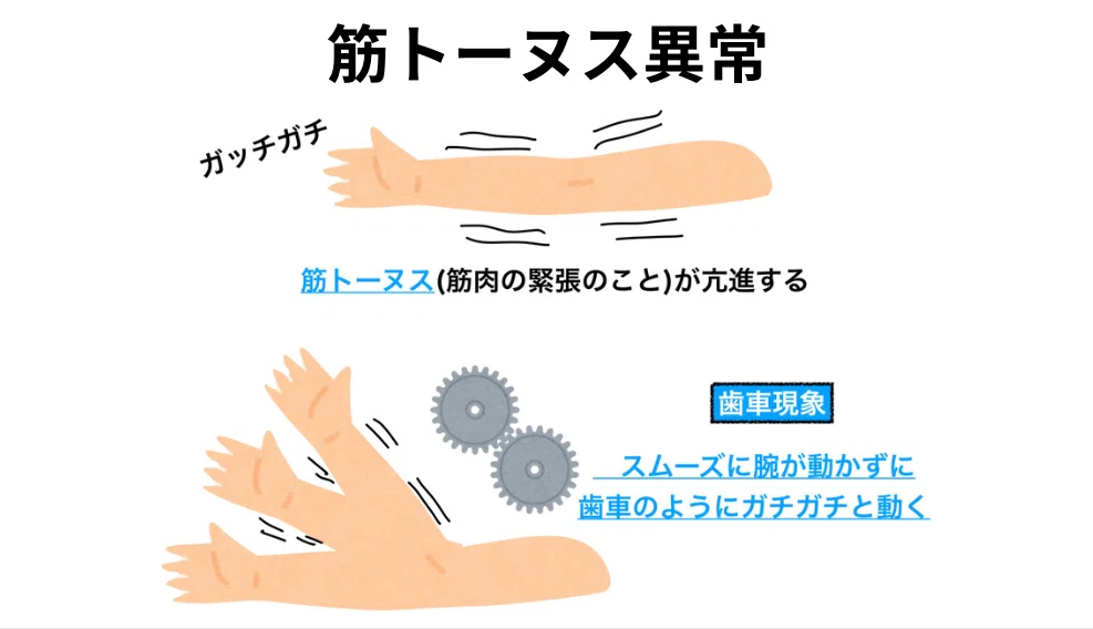 筋トーヌス異常の分類と、それぞれに対応する物理療法のアプローチを整理した図