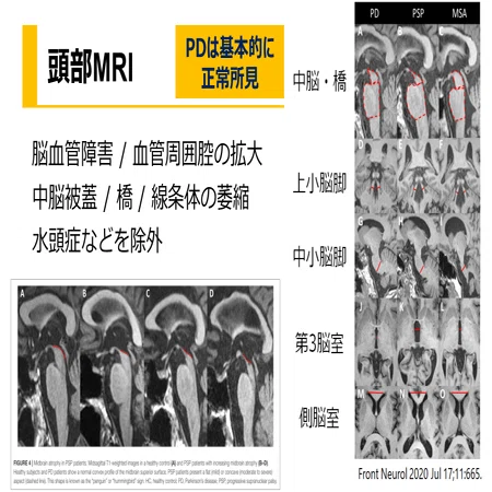 パーキンソン病の鑑別疾患とは｜Dr. タワマン