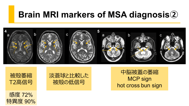 パーキンソン病 パーキンソン病の検査・診断 - 独立行政法人国立病院機構 鳥取
