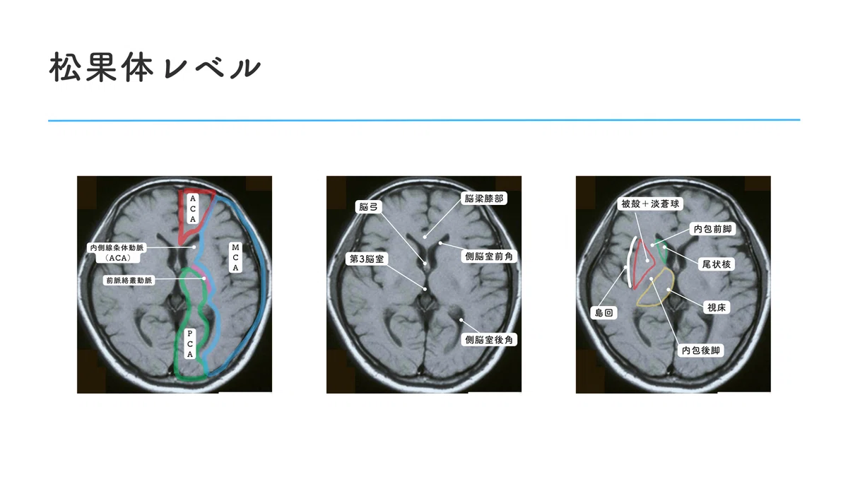 脳画像の見かた~基本編~|かずさん|脳画像を楽しく攻略
