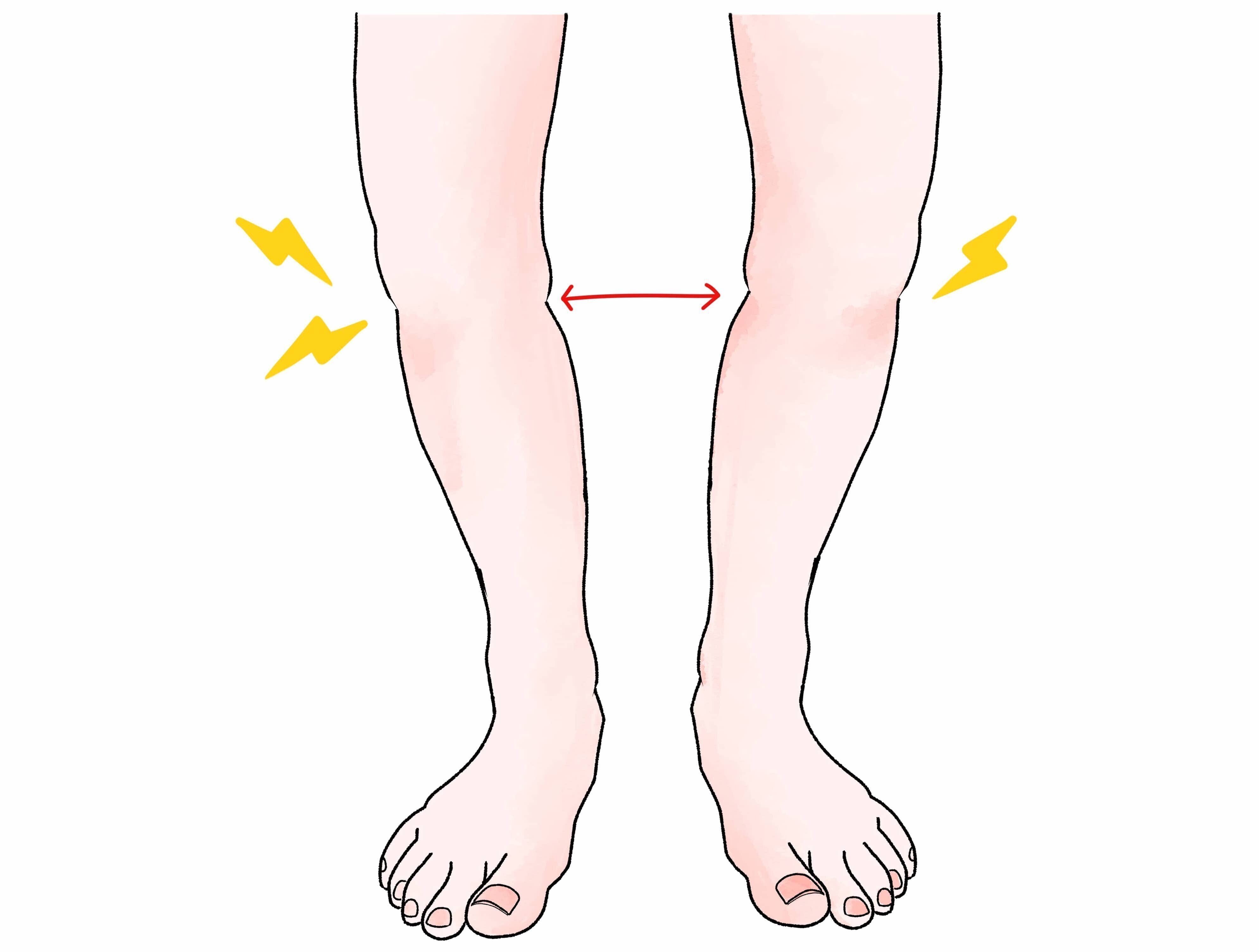 変形性膝関節症の臨床評価とアプローチ【サブスク】｜理学療法士による