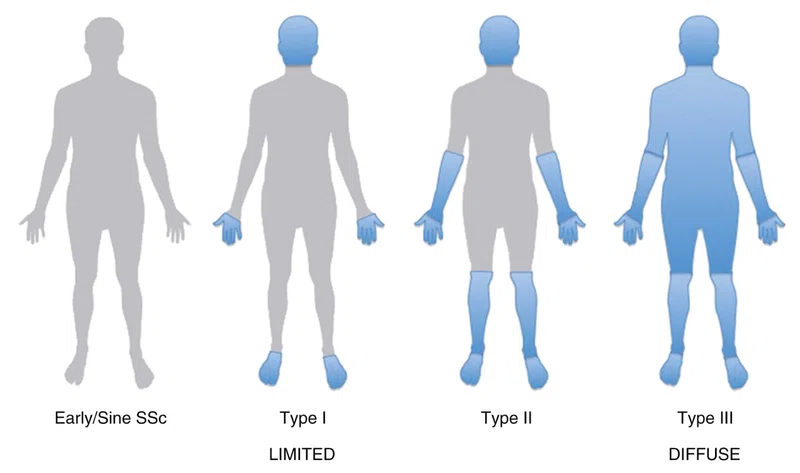 89 強皮症の臨床的特徴と治療 Clinical Features and Treatment of Scleroderma｜Takizawa ...