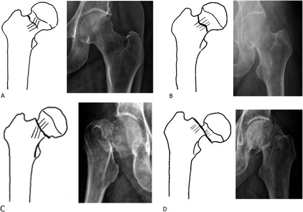 大腿骨近位部骨折 Osteosynthesis & Arthroplasty 大腿骨近位部骨折