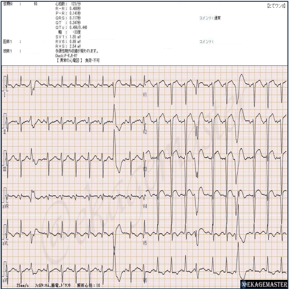 Dr.ヒロの心電図ワンポイント8｜えかげますたぁ｜Dr.ヒロ