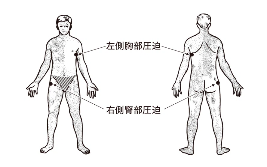 半側発汗の現象を示す図。体の一側を圧迫すると同側の発汗が抑制され、反対側で発汗が増える