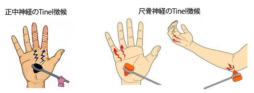 第59回理学療法士国家試験 午前31-35の解説｜Sixty_valleyのページ