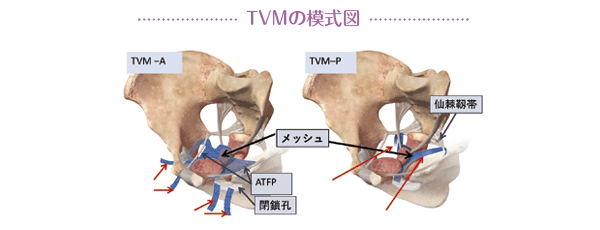 人気便利グッズ 疾患センター解説】骨盤臓器脱、尿もれなど女性の悩みの力強い 医学一般