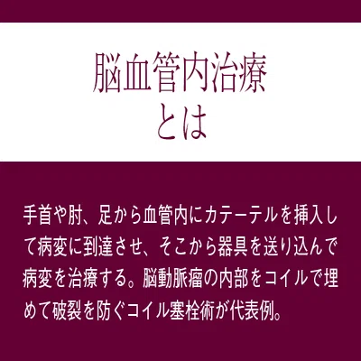 手術の名医たち】脳疾患治療 脳血管内治療の発展と共に歩み最新手技の