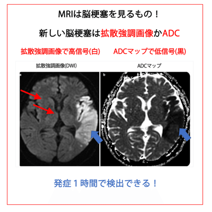 第59回理学療法士国家試験 午前86-90の解説｜Sixty_valleyのページ