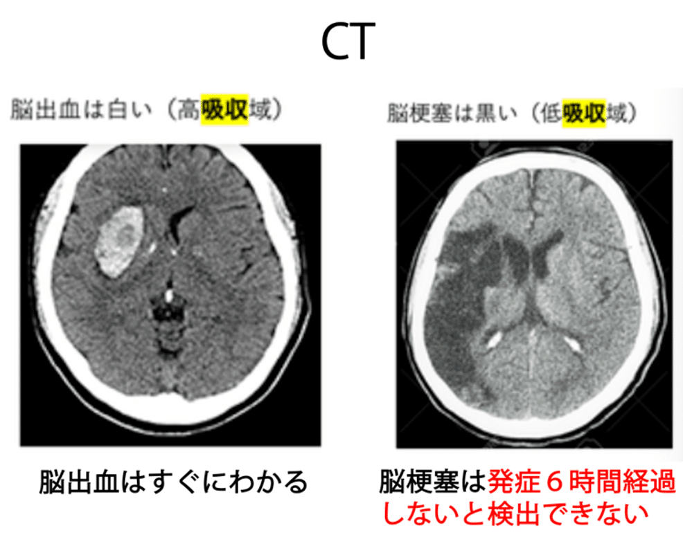 脳卒中、脳画像3点セット 第59回理学療法士国家試験 午前86-90の解説｜Sixty_valleyのページ