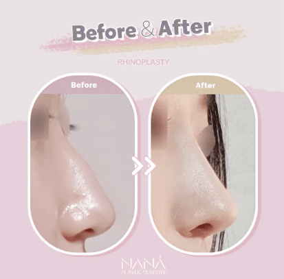 韓国整形　韓国美容外科　小鼻　鼻整形　プロテーゼ　鷲鼻　アップノーズ