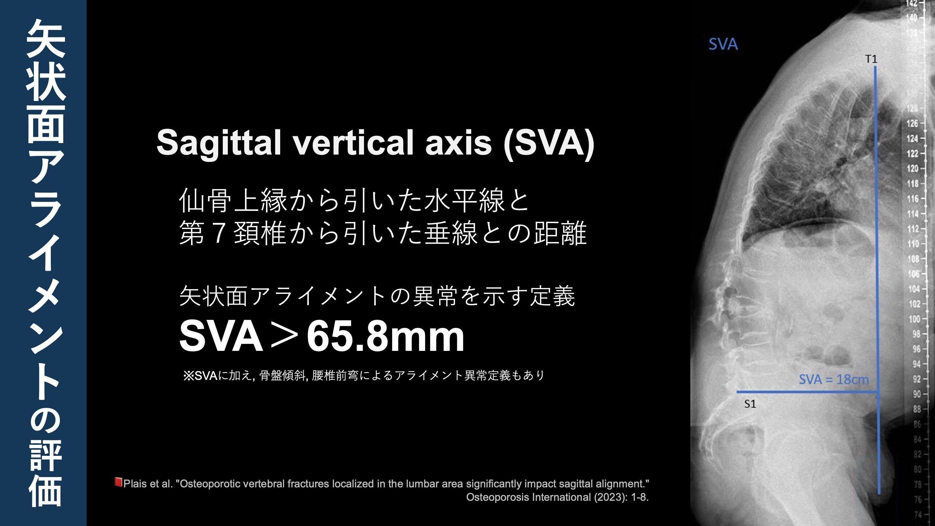 椎体骨折患者の◯%が矢状面アライメント異常？｜Super Human | 理学