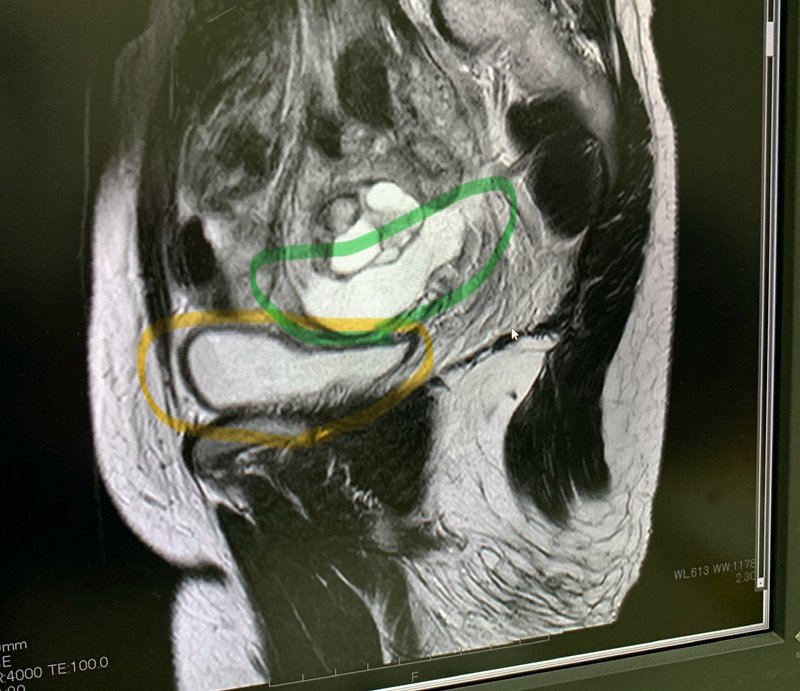 卵巣嚢腫ではなく腹膜封入嚢胞　私のMRI画像