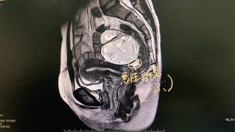 私の卵巣嚢腫と悪性所見が見られると言われた部分　2房性皮様嚢腫MRI画像