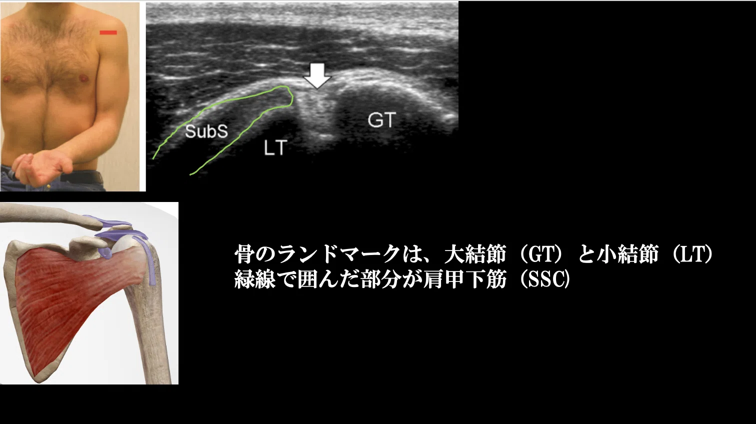 超音波解剖追記④（肩甲下筋について）｜こばさん（小林由弥）