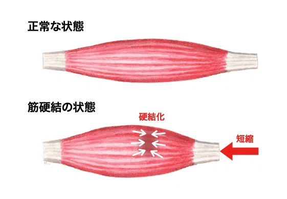 凝りの定義|CORI LABO®︎