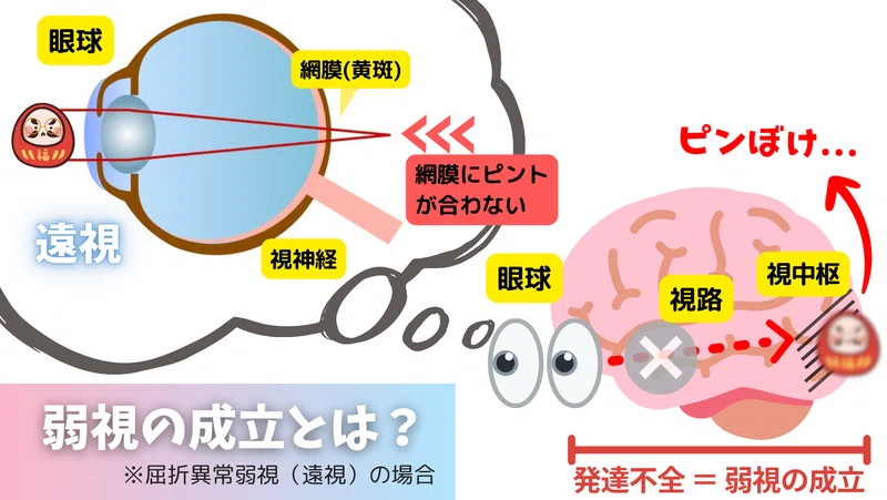 子どもの弱視ガイド|現役視能訓練士が徹底解説!読めば必ず理解できる!|視能訓練士ヤスの眼科臨床まとめノート