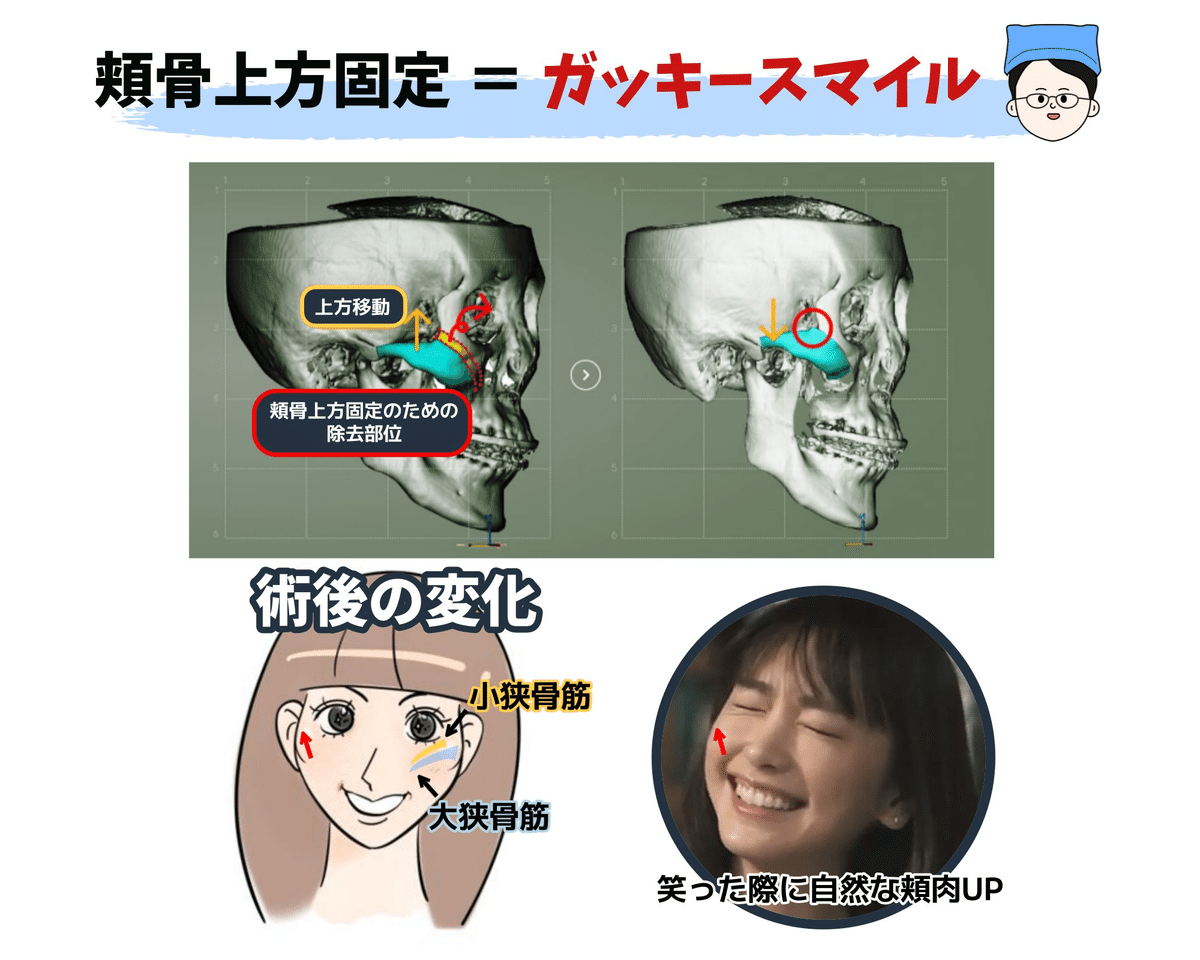 頬骨縮小手術総集編（24年2月基準）】｜【輪郭・両顎】マックス