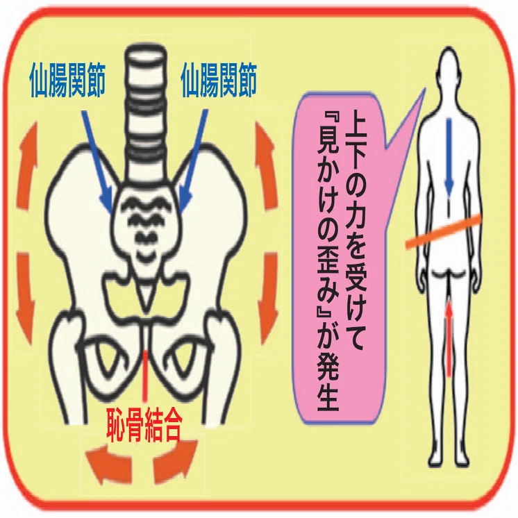 骨盤は歪みません!?④～「骨盤矯正」と「見かけの歪み」／連載コラム