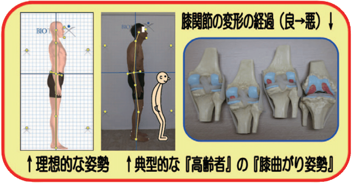 サラバ高齢者体型④～関節の変形にご用心!!／連載コラム vol.29