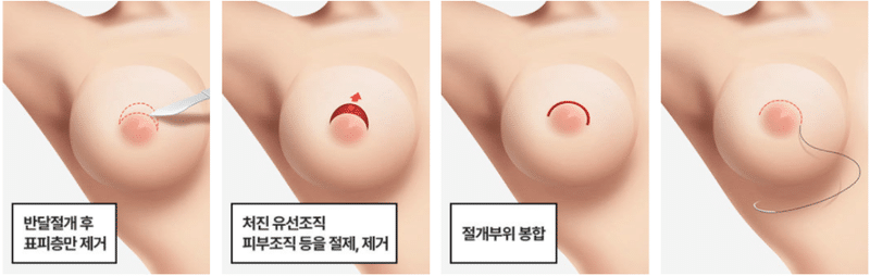 韓国整形 豊胸 谷間 バストアップ 垂れ乳