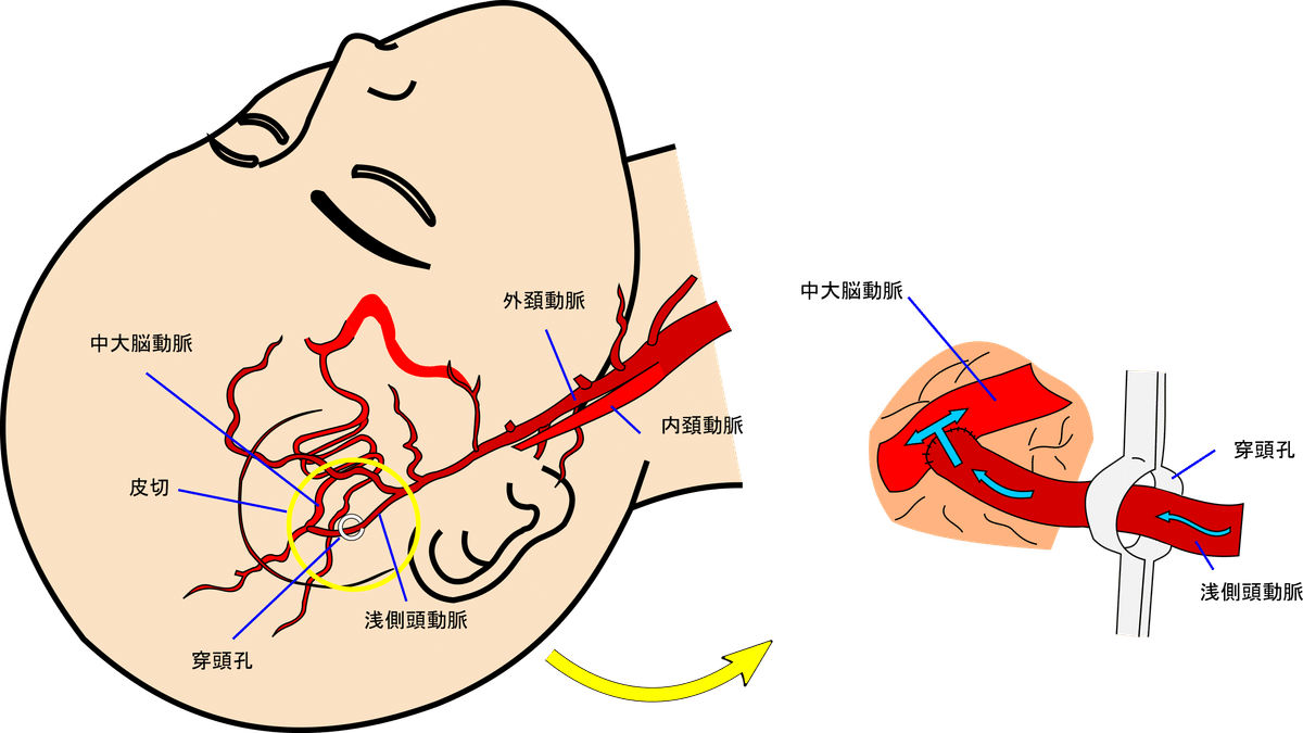 側頭骨蝶形骨と無血手術 Dr.M.L.REES 側頭骨蝶形骨と無血手術 Dr.M.L.REES