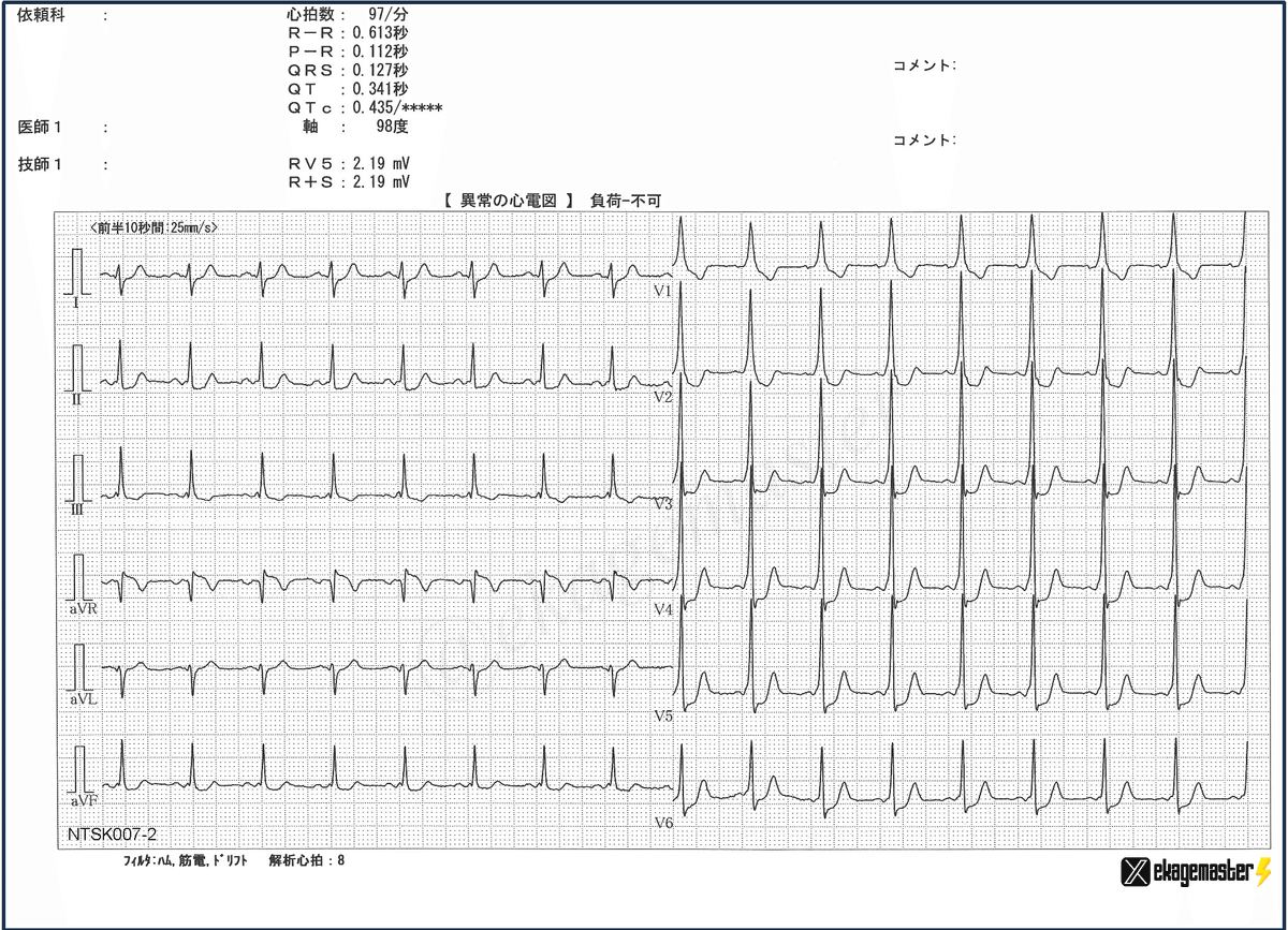 心電図検定対策講座【問題7】｜えかげますたぁ｜Dr.ヒロ