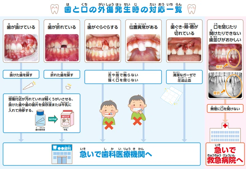 こどもの歯の外傷｜Reina歯科医院