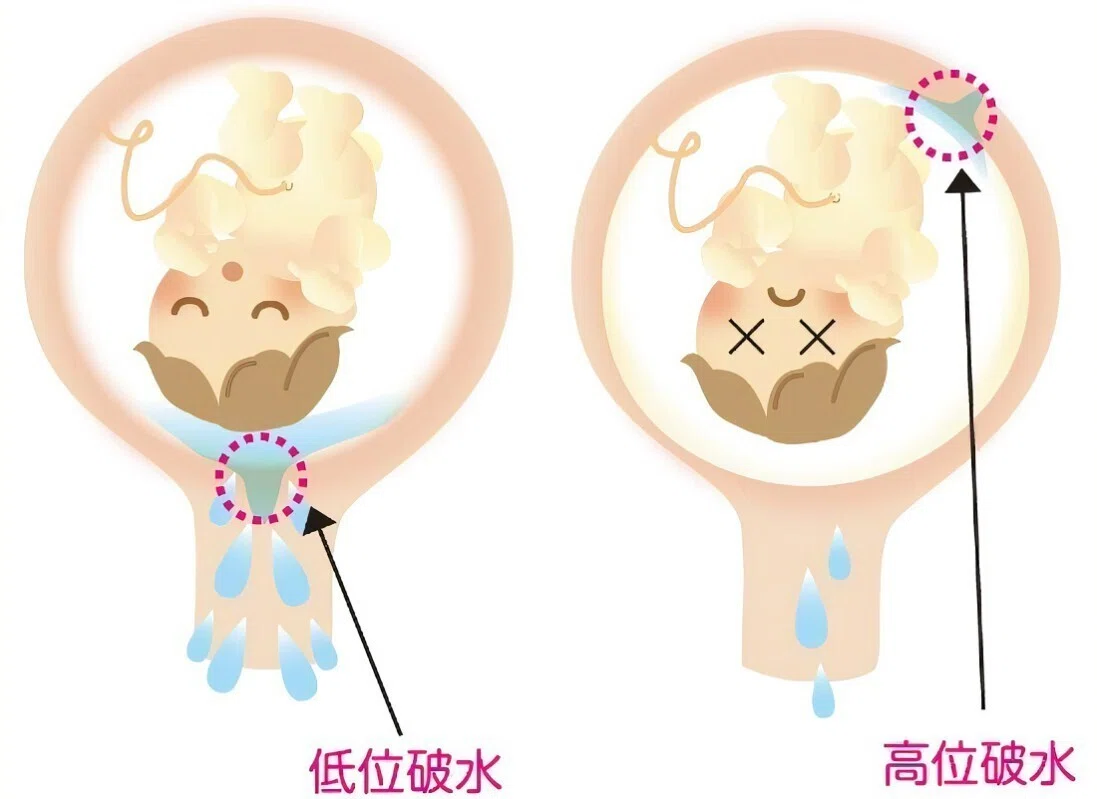 破水 どんな 感じ