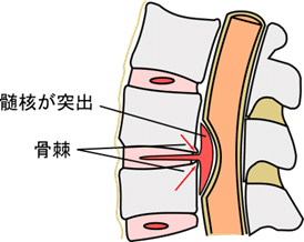 脊椎・脊髄疾患 #10-2 脊椎・脊髄の疾患｜脳卒中リハビリテーション