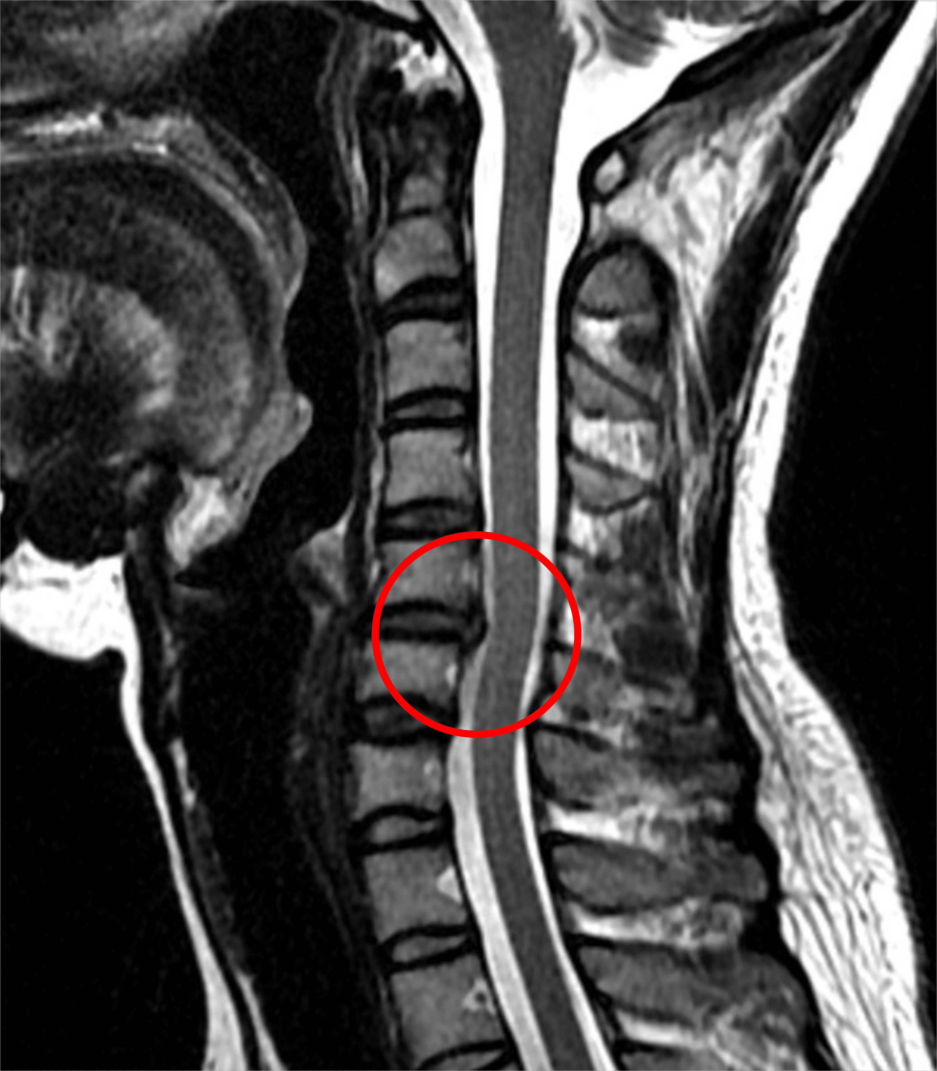 エキスパートのための脊椎脊髄疾患のMRI 【裁断済み】エキスパートの