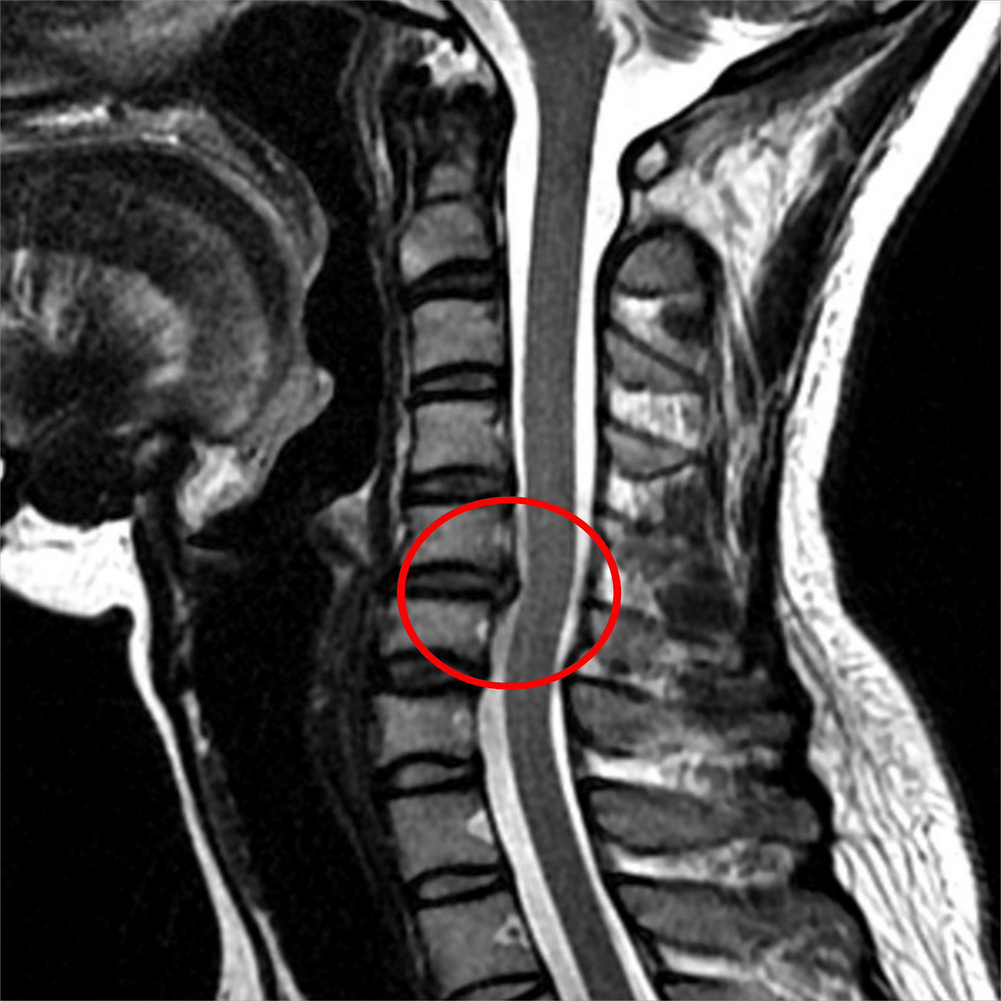 脊椎・脊髄疾患 #10-2 脊椎・脊髄の疾患｜脳卒中リハビリテーション