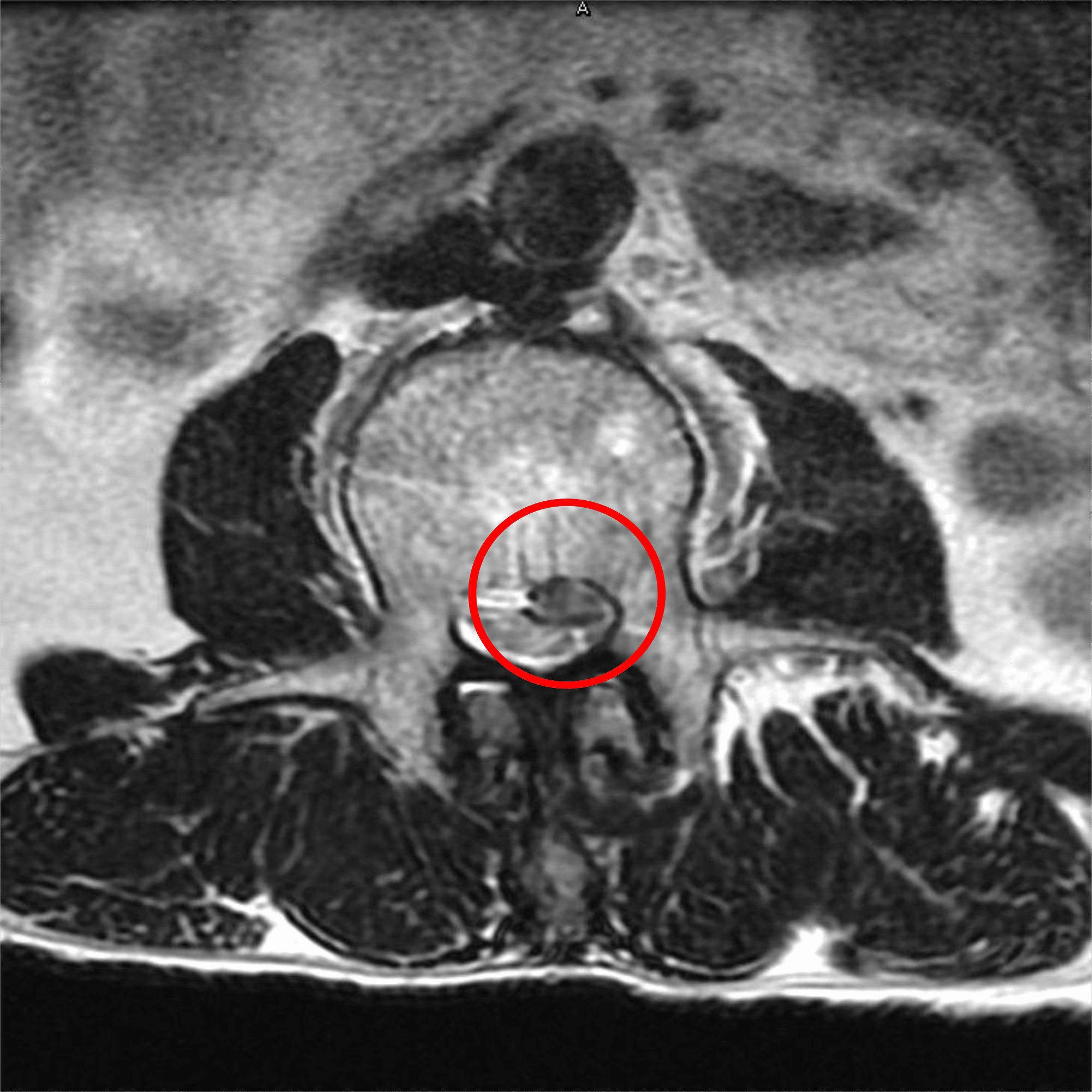 脊椎・脊髄疾患 #10-2 脊椎・脊髄の疾患｜脳卒中リハビリテーション