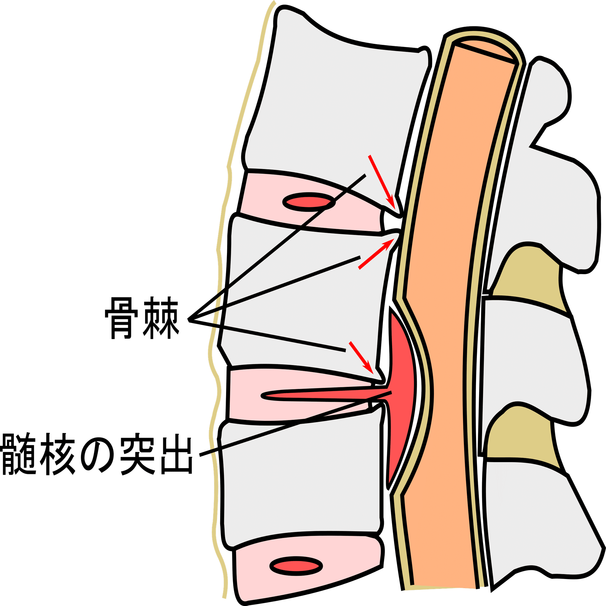 脊椎・脊髄疾患 #10-2 脊椎・脊髄の疾患｜脳卒中リハビリテーション