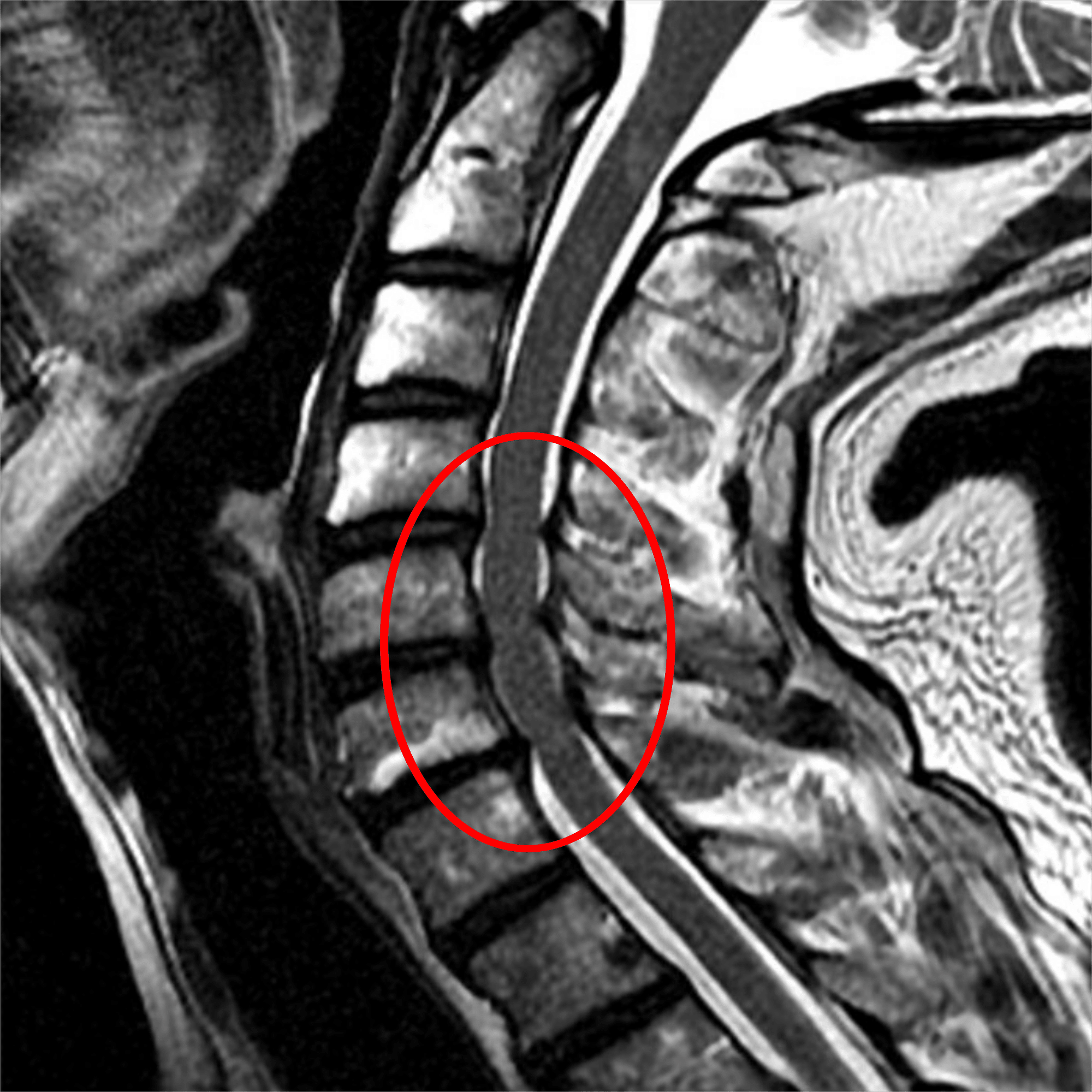 脊椎・脊髄疾患 #10-2 脊椎・脊髄の疾患｜脳卒中リハビリテーション