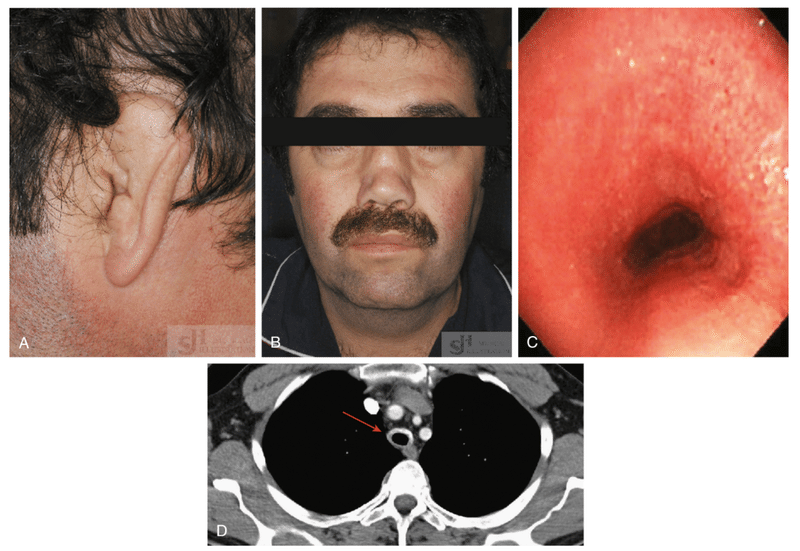 再発性多発性軟骨炎とは何ですか?