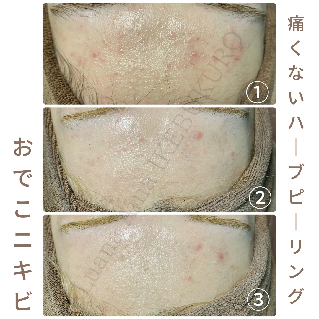 おでこのハーブピーリング】初回〜3回目までの変化｜肌改善＆ハーブ