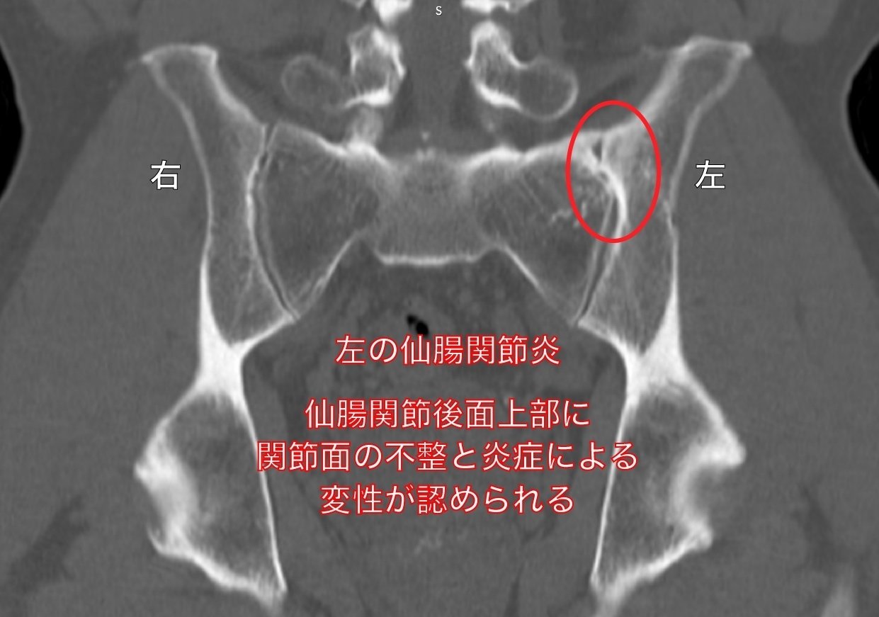 トップアスリートと仙腸関節障害｜西村 公典